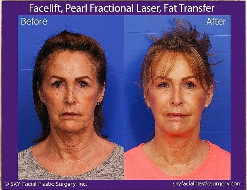 Facelift Before & After