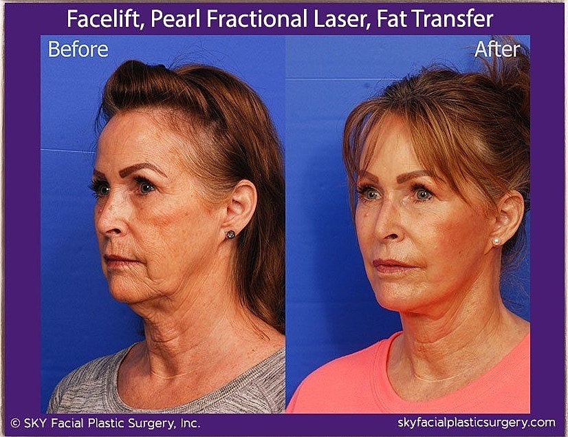 Facelift Before & After