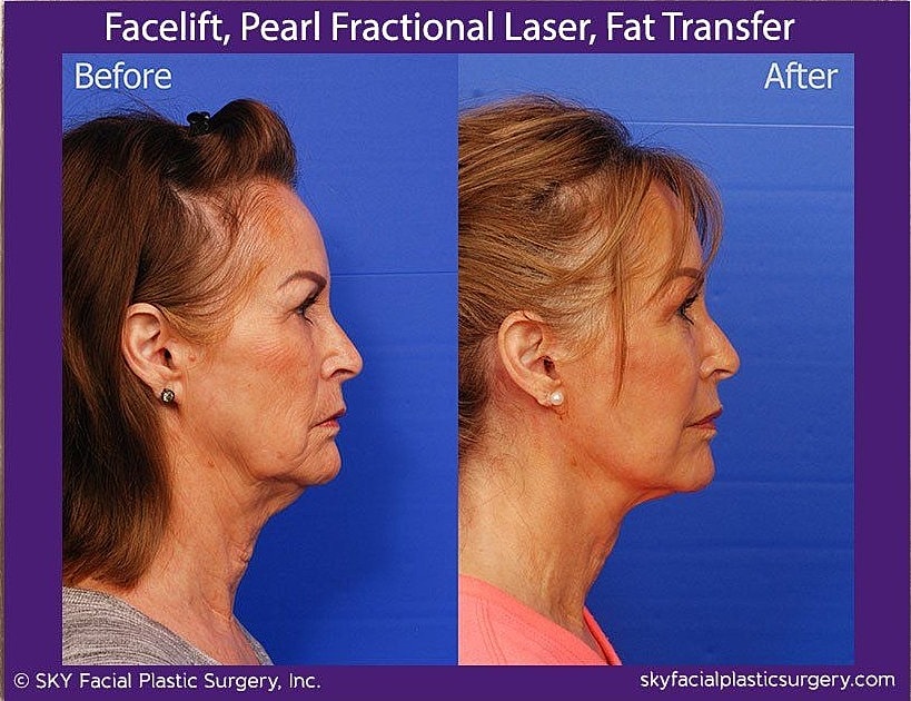 Facelift Before & After