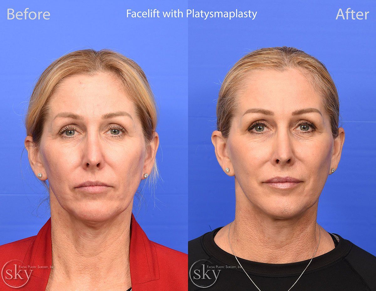 Facelift Before & After