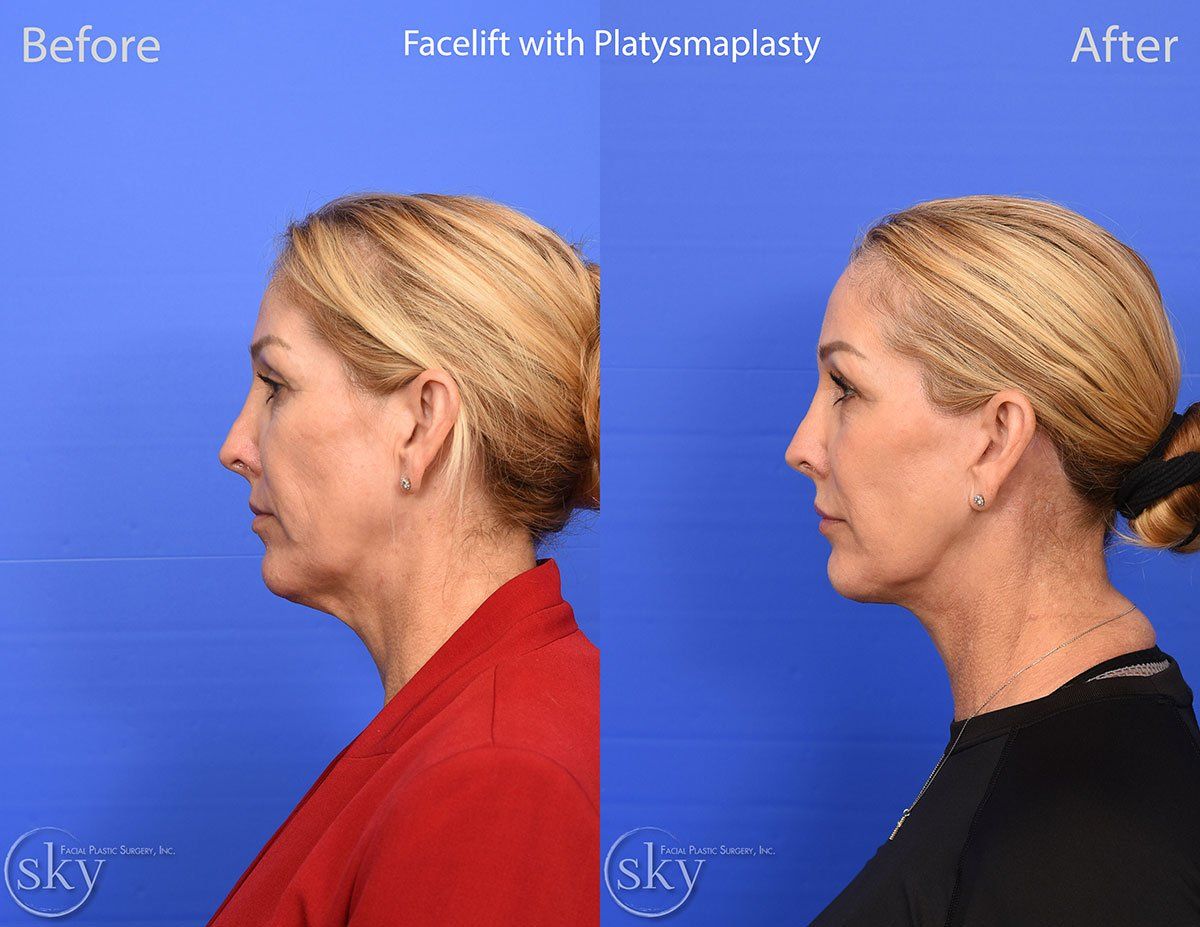 Facelift Before & After