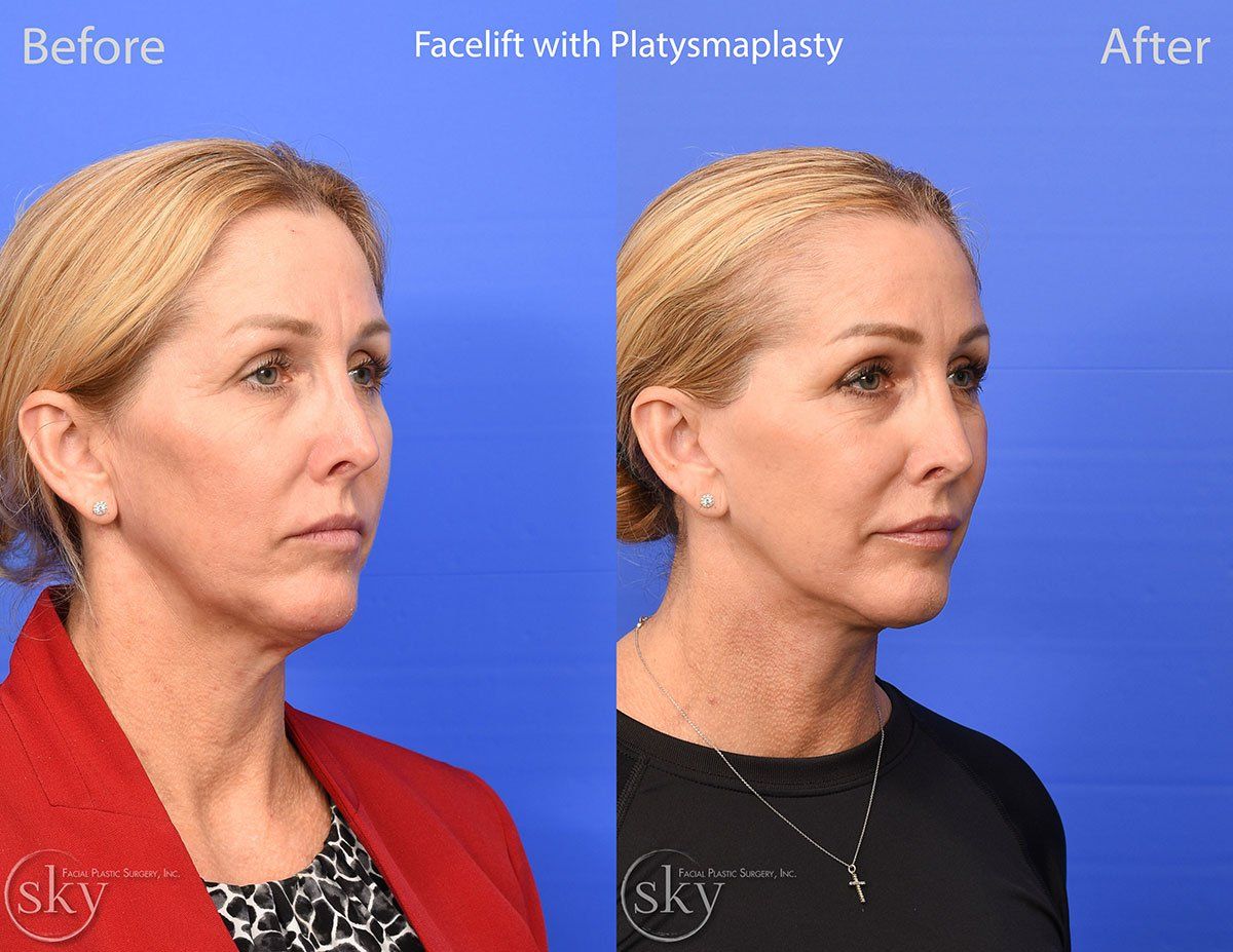Facelift Before & After