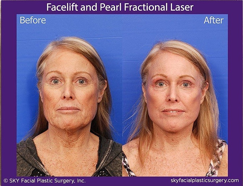 Facelift Before & After