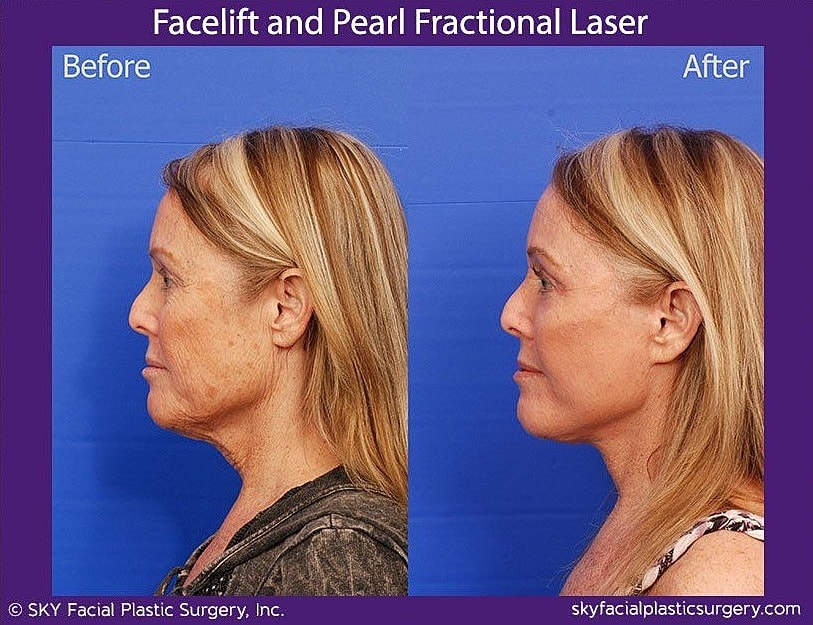 Facelift Before & After