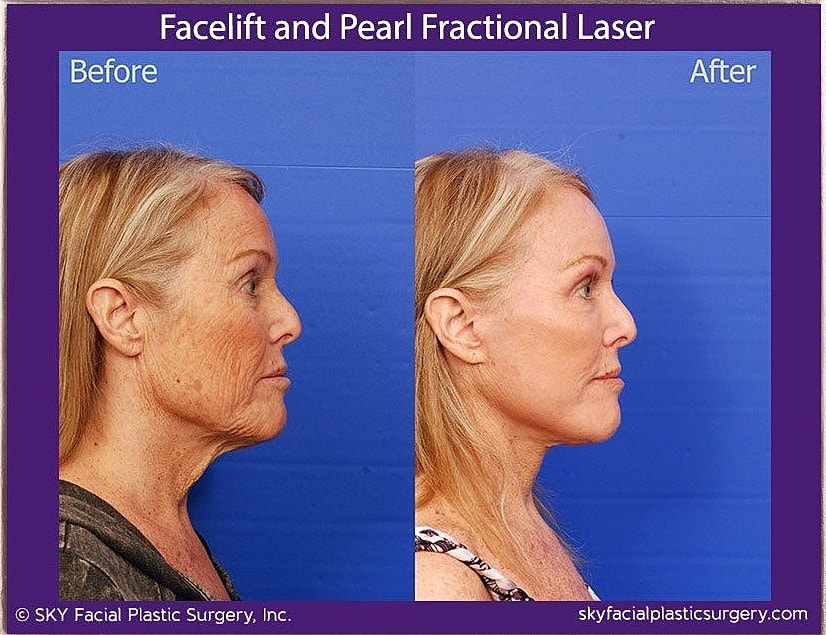 Facelift Before & After