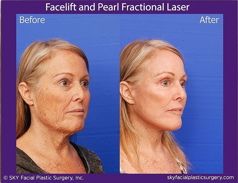 Facelift Before & After