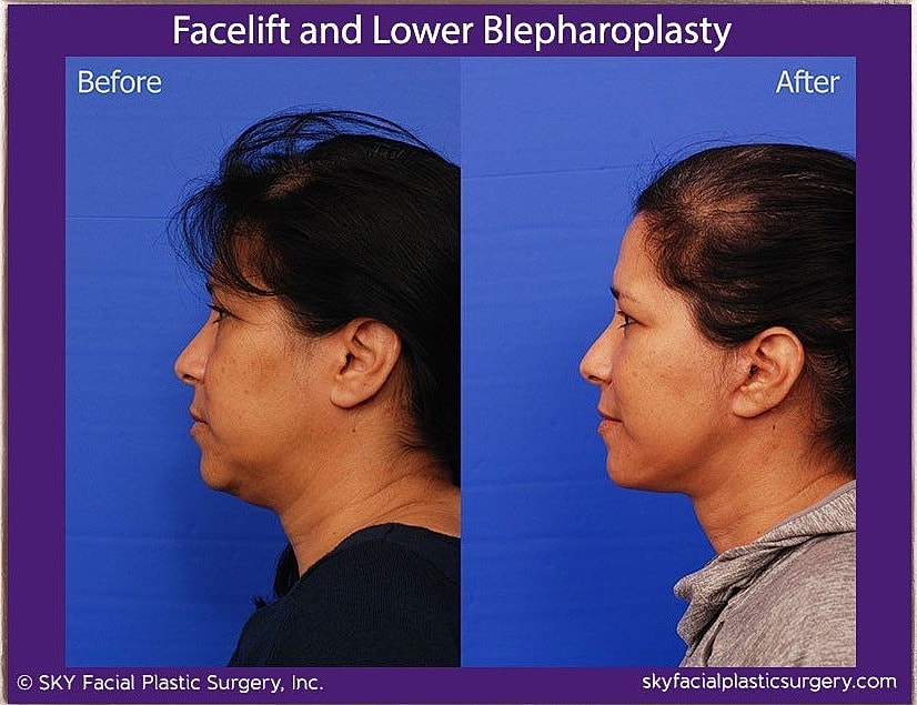 Facelift Before & After