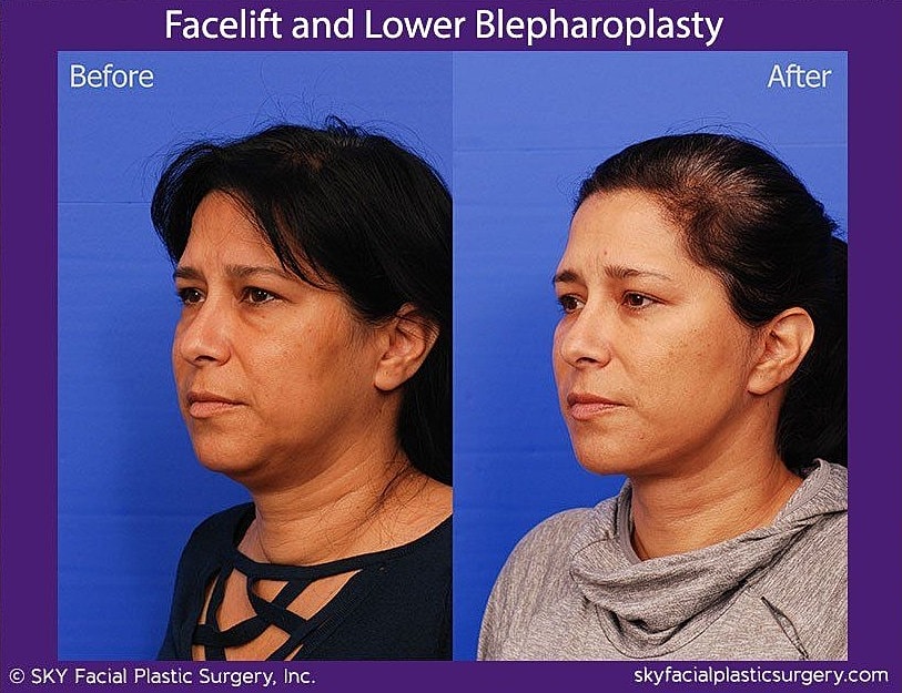 Facelift Before & After