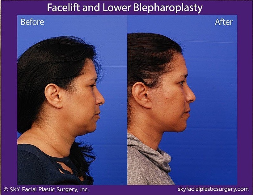 Facelift Before & After