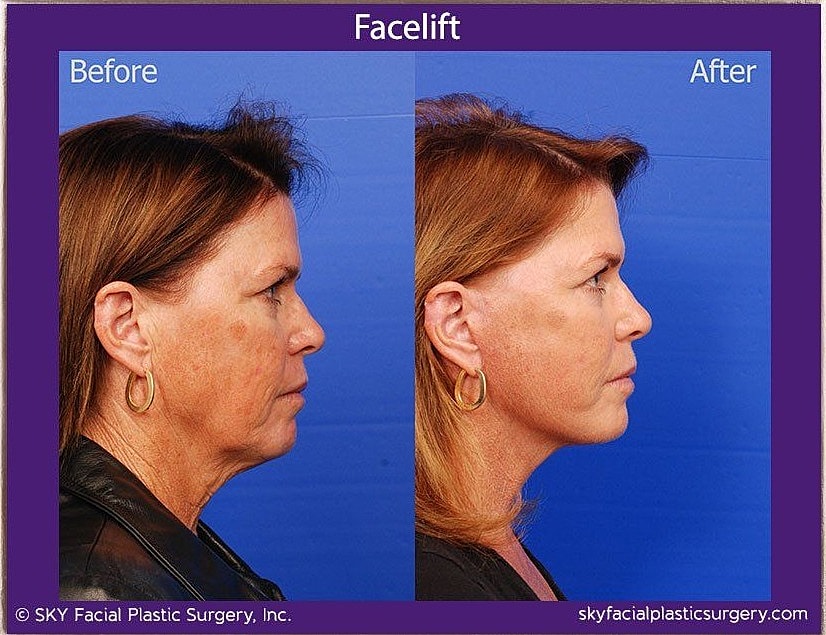 Facelift Before & After