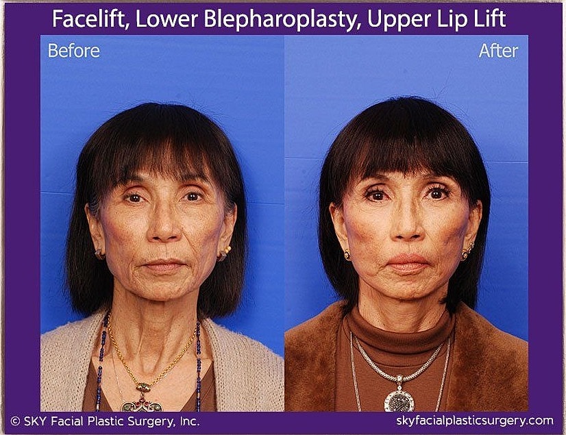Facelift Before & After
