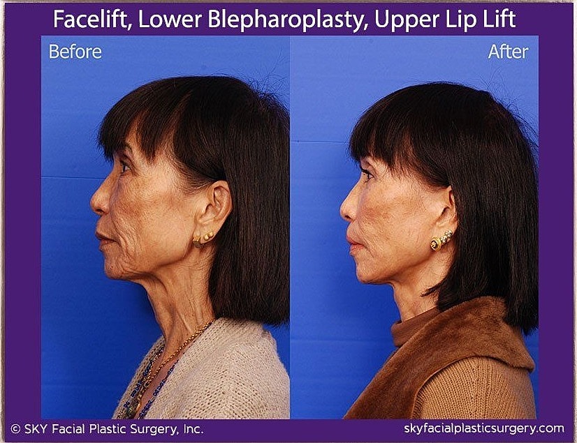 Facelift Before & After