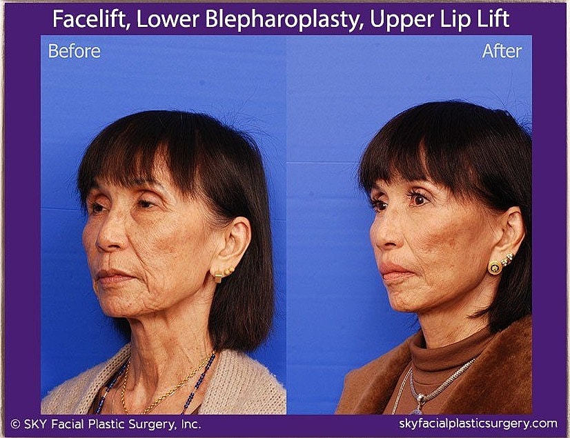 Facelift Before & After