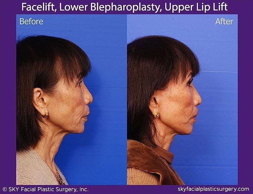 Facelift Before & After