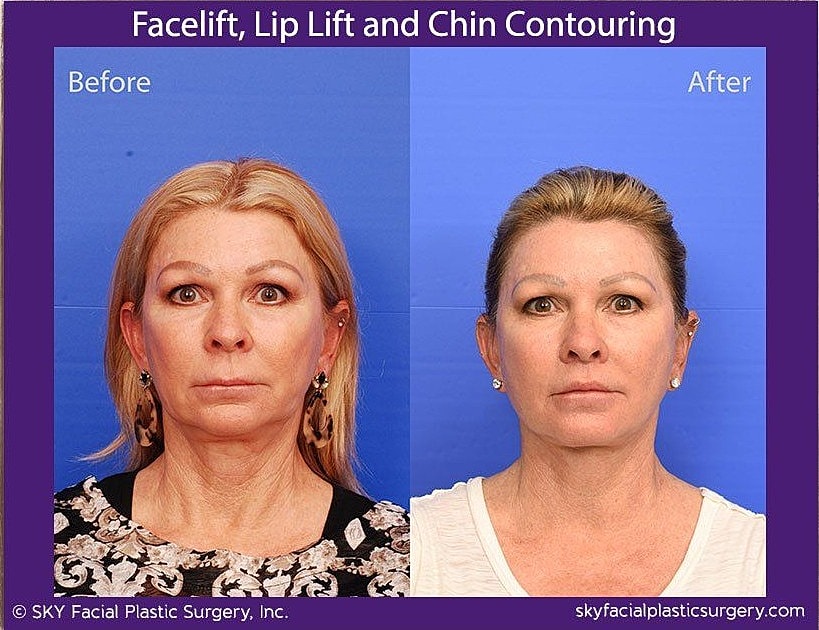 Facelift Before & After