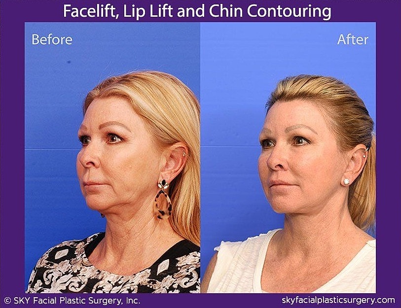 Facelift Before & After