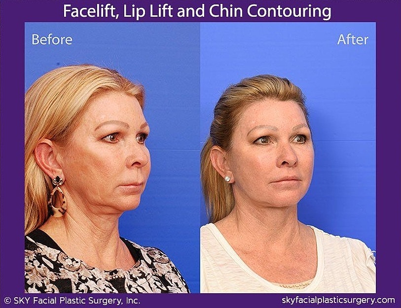 Facelift Before & After