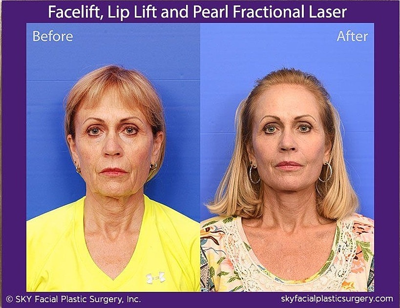 Facelift Before & After