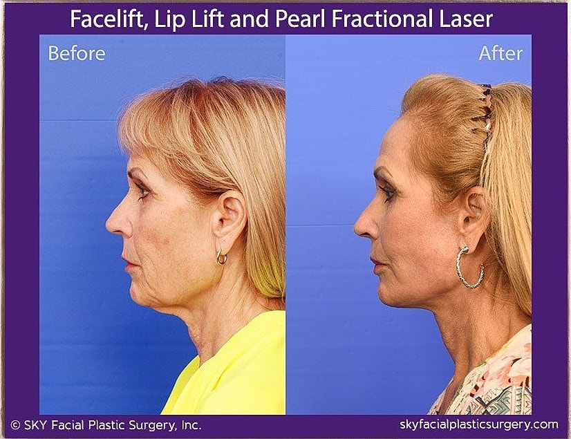 Facelift Before & After