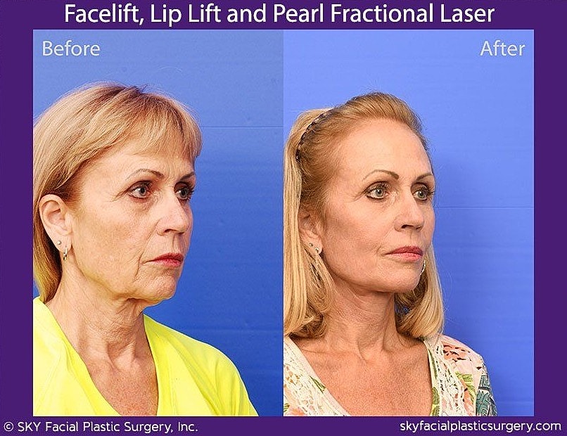 Facelift Before & After