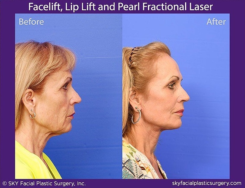Facelift Before & After