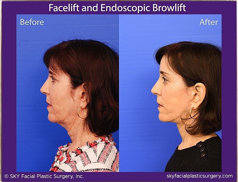 Facelift Before & After
