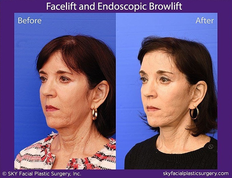 Facelift Before & After