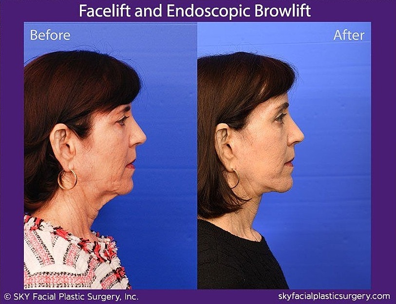 Facelift Before & After