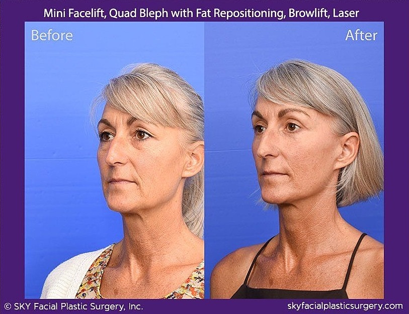 Facelift Before & After