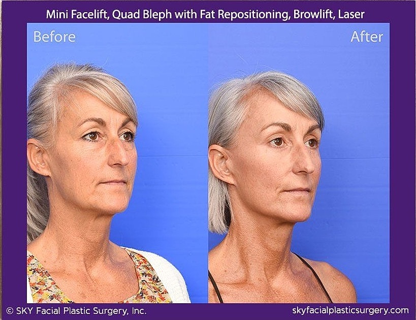Facelift Before & After