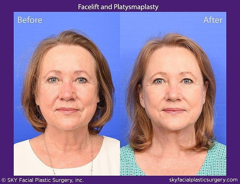Facelift Before & After