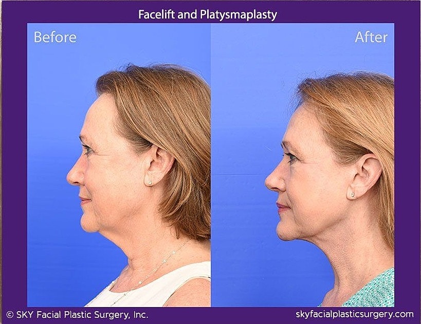 Facelift Before & After
