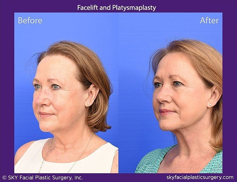Facelift Before & After