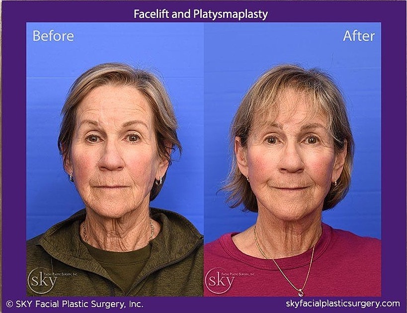 Facelift Before & After