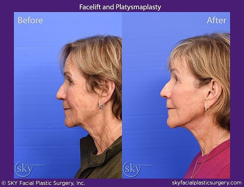 Facelift Before & After
