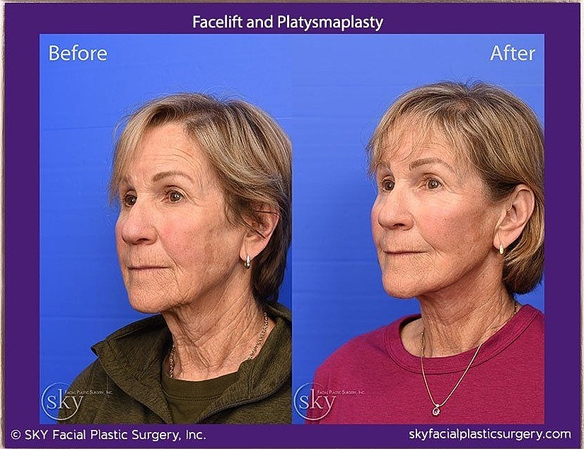 Facelift Before & After