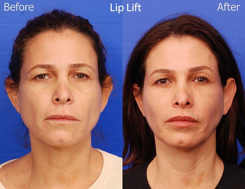 Lip Lift Before & After