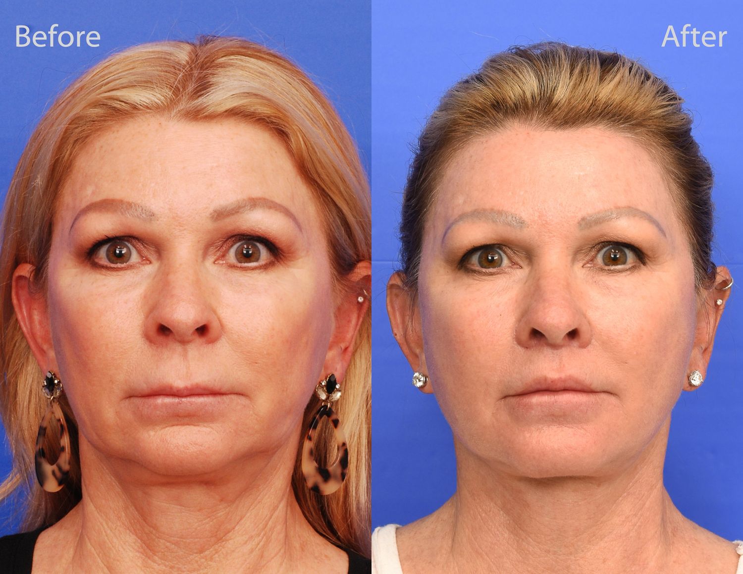 Lip Lift Before & After