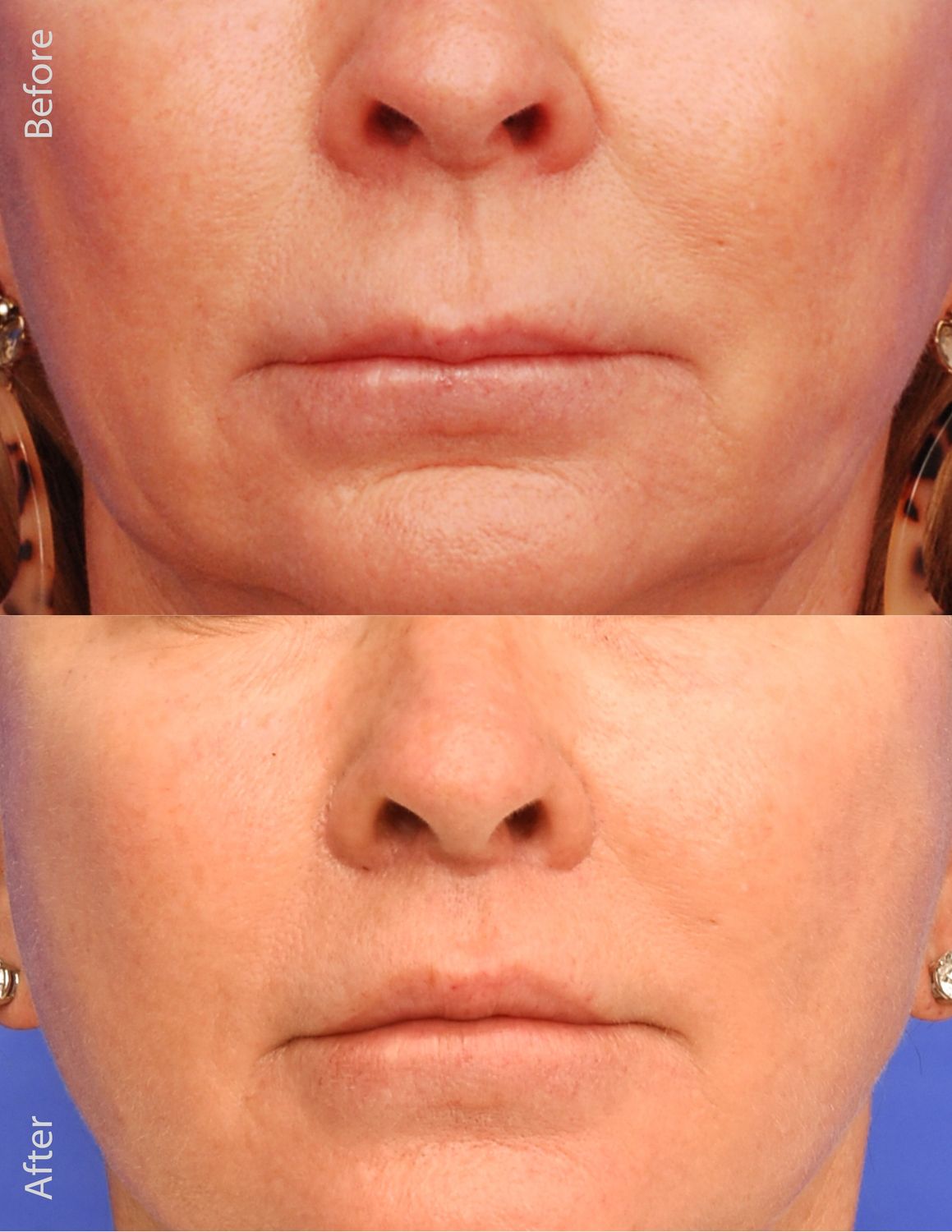 Lip Lift Before & After