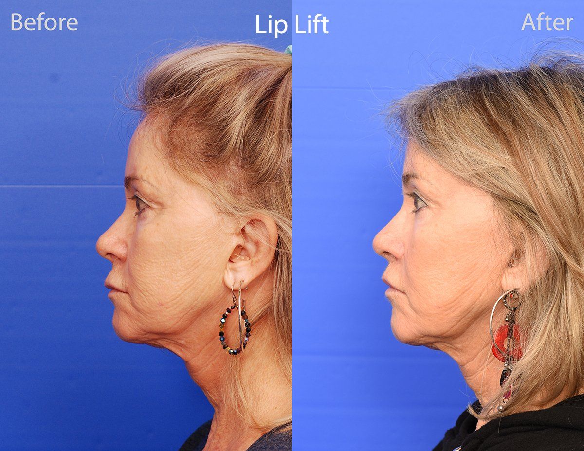 Lip Lift Before & After