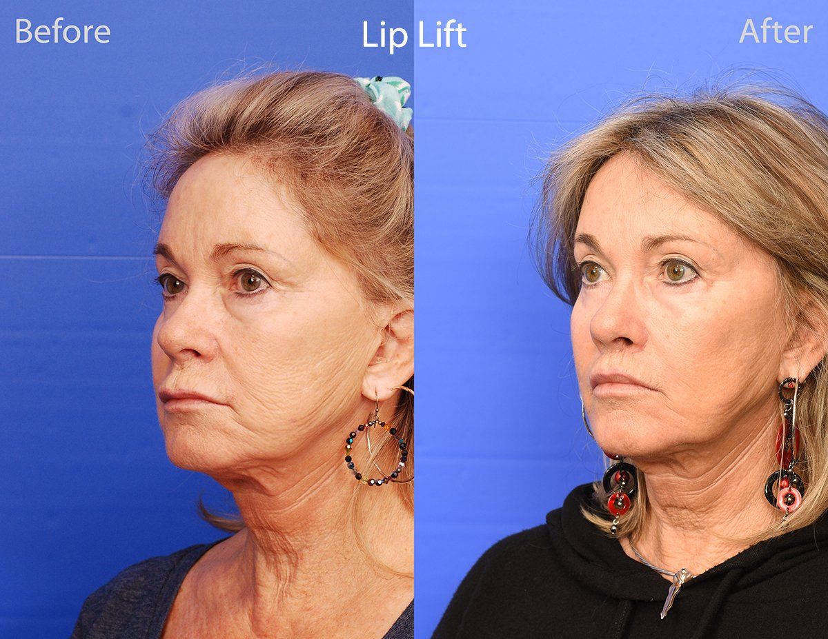 Lip Lift Before & After