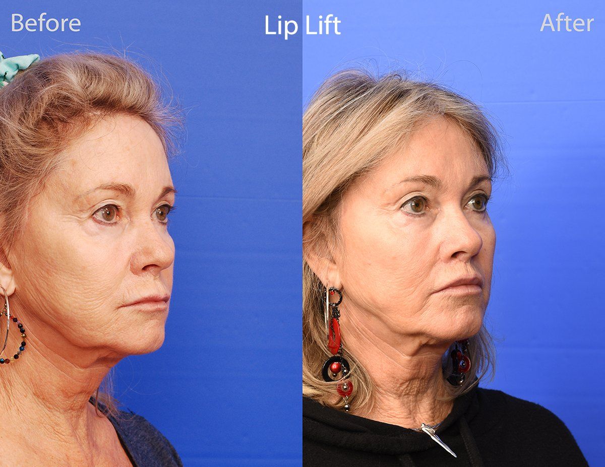 Lip Lift Before & After