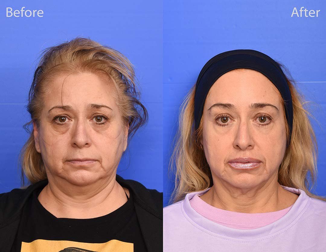 Lip Lift Before & After