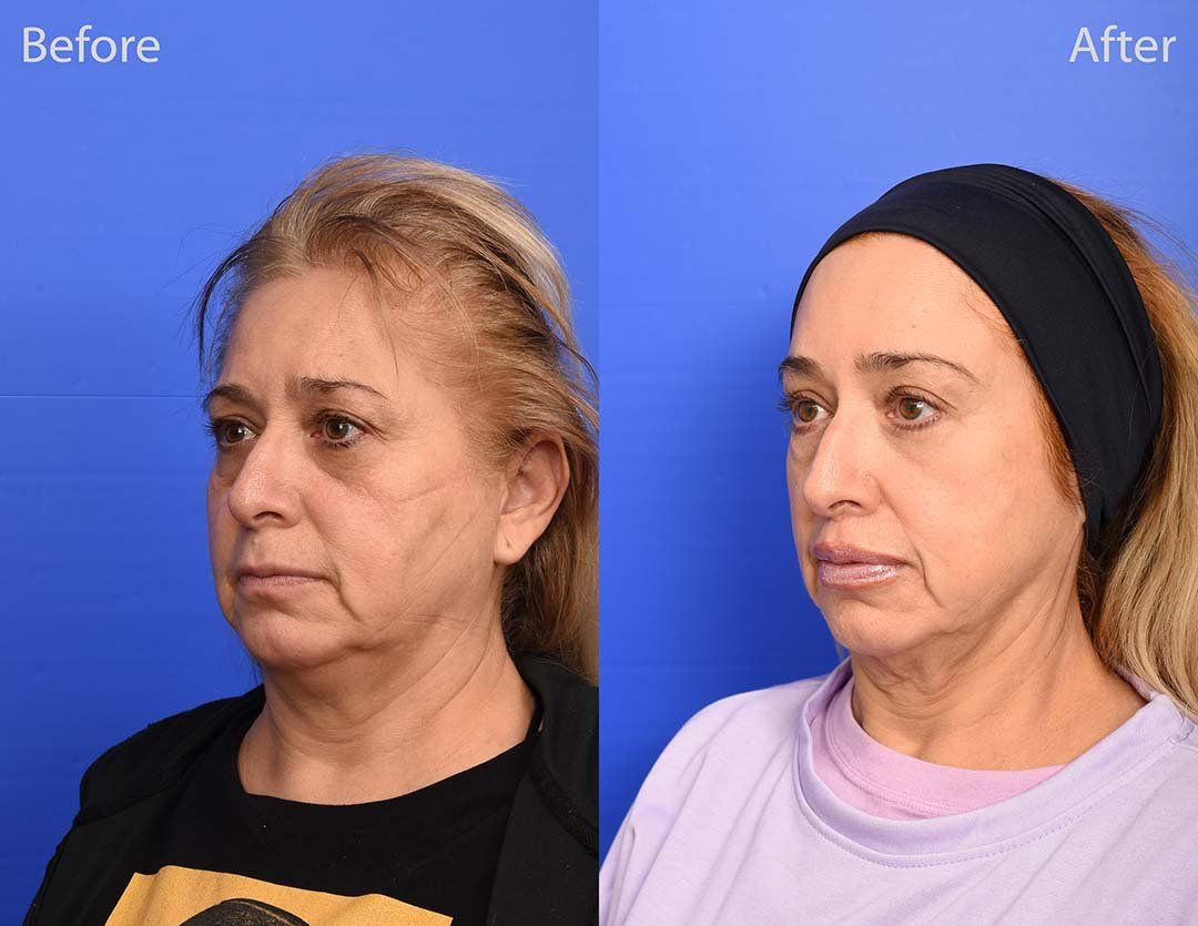 Lip Lift Before & After