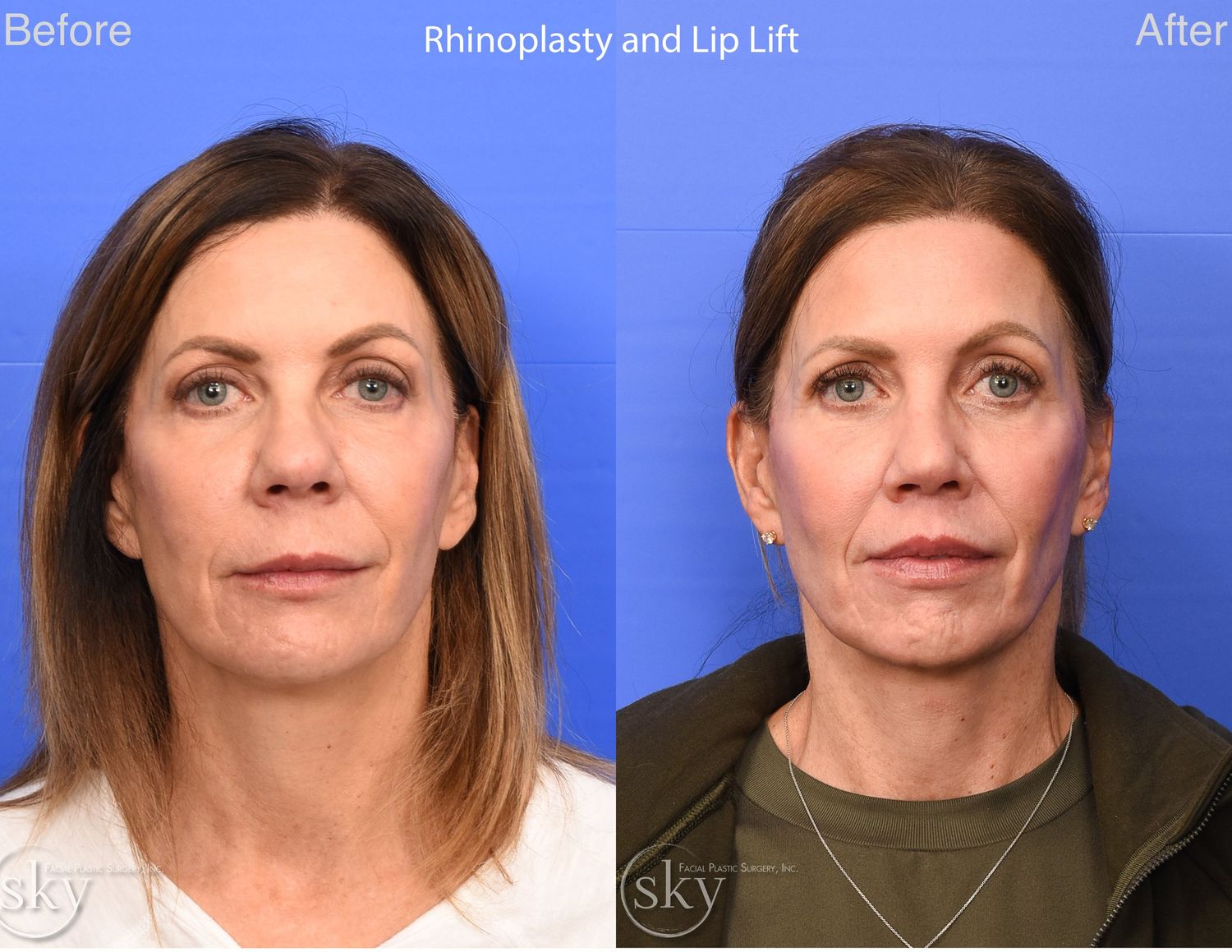 Lip Lift Before & After