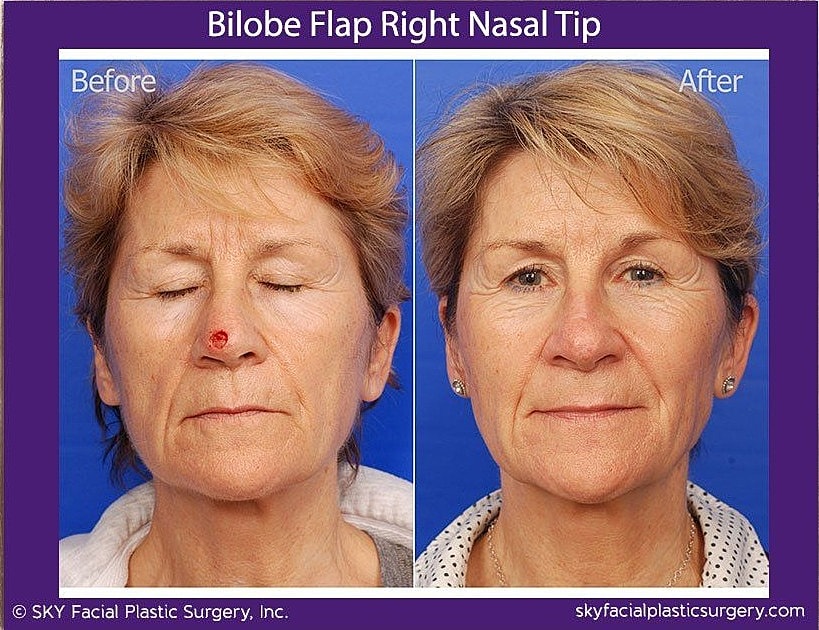 Mohs Reconstruction Before & After