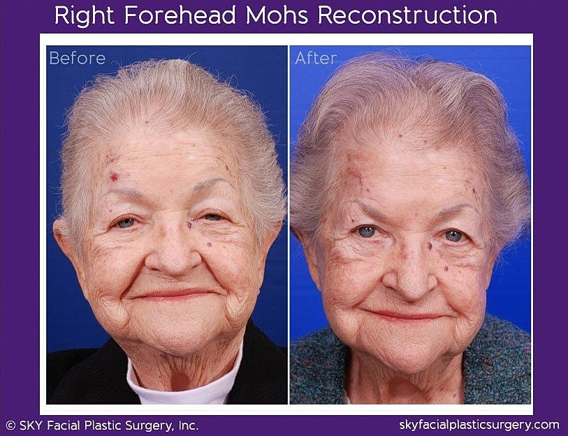 Mohs Reconstruction Before & After