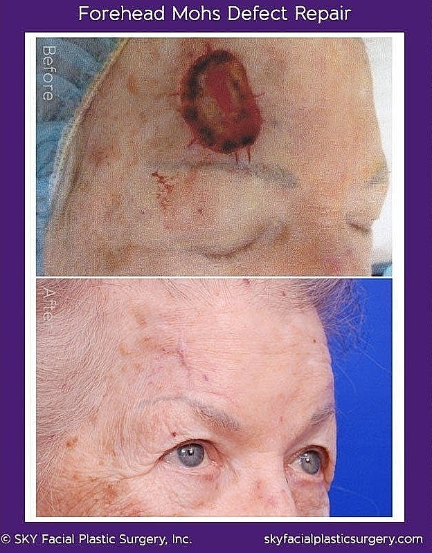 Mohs Reconstruction Before & After