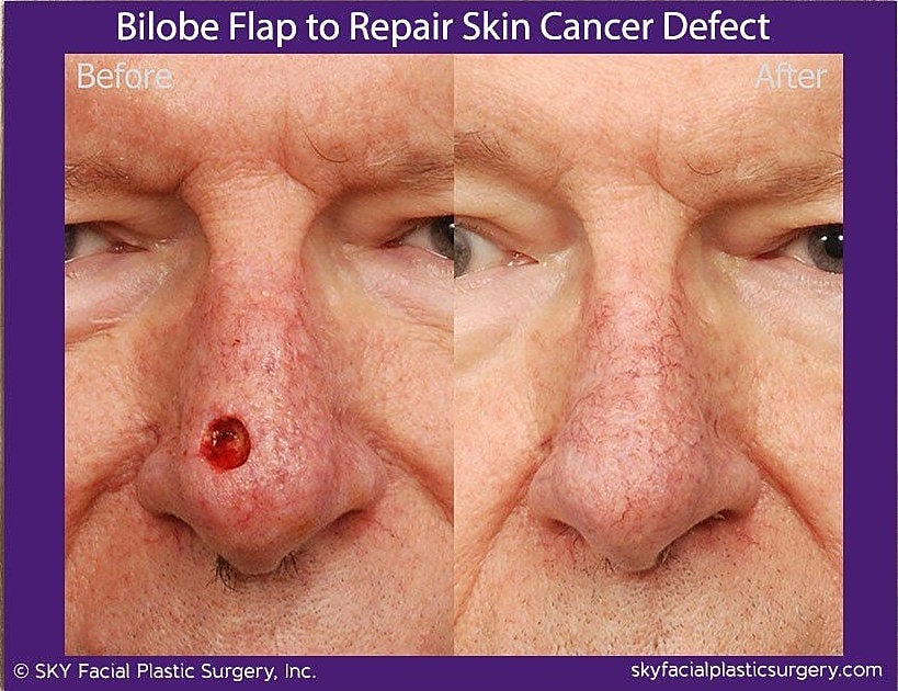 Mohs Reconstruction Before & After
