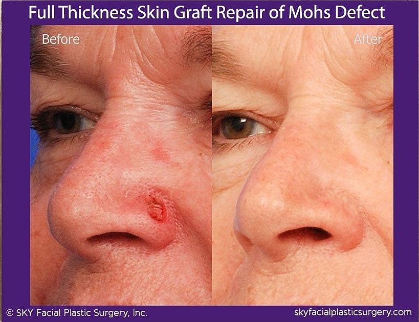 Mohs Reconstruction Before & After